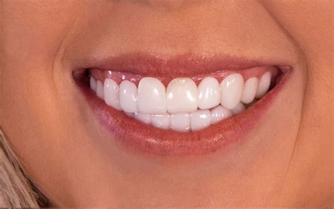 Free Veneers From Brighter Image Lab Web I Decided To Do Another ...