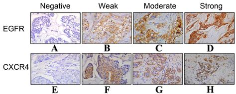 EGFR expression is associated with cytoplasmic staining of CXCR4 and predicts poor prognosis in ...