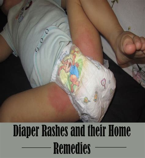 Diaper Rashes and their Home Remedies: | Home remedies, Diaper rash, Diaper girl