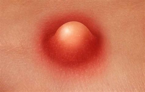 6 Signs of a Staph Infection You Should Never Ignore, According to Doctors | Staph infection ...