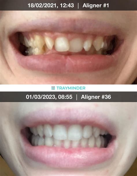 Done! 76 trays, elastics, bite ramps and power ridges : r/Invisalign