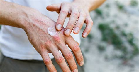 Dry Skin On Hands - Causes, Prevention & Cure | O’Keeffe’s | O'Keeffe's ...