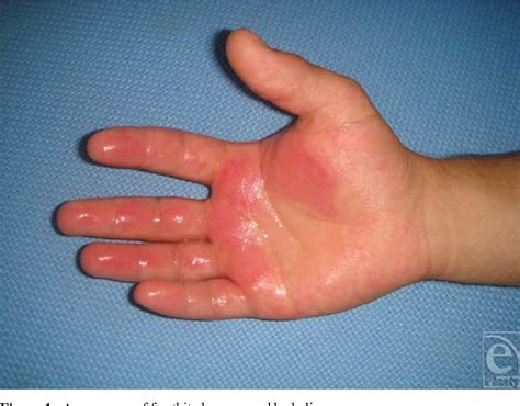 Figure 1 from Frostbite Injury of Hand Caused by Liquid Helium: A Case Report | Semantic Scholar