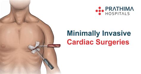 Minimally Invasive Cardiac Surgery - Best Hospital in Hyderabad | Best Hospital in Kukatpally ...