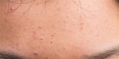 Sweat Pimples: Causes, Treatments & Prevention Tips