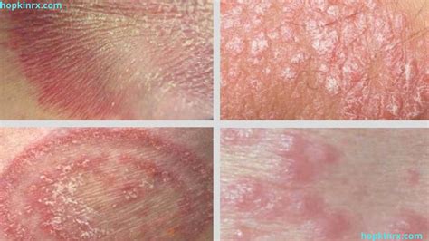 Jock Itch Or Tinea cruris: 3 Main Symptoms, Causes, Diagnosis And Complete Treatments - Hopkin Rx