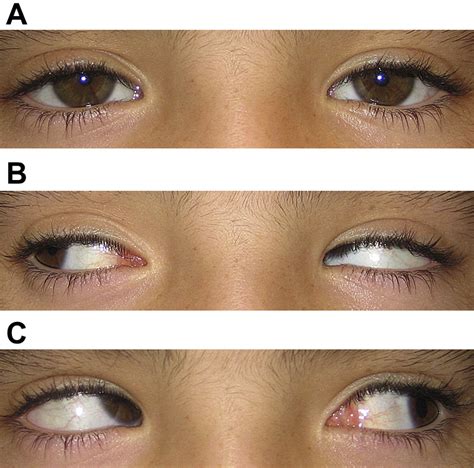 Paralytic Strabismus: Third, Fourth, and Sixth Nerve Palsy - Neurologic Clinics