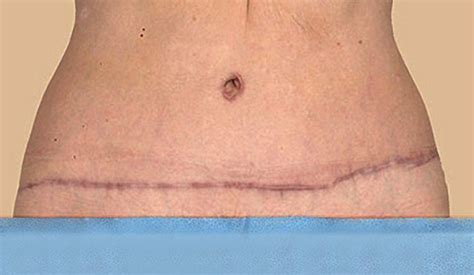 Tummy Tuck Scar: Healing, Treatment & Revision