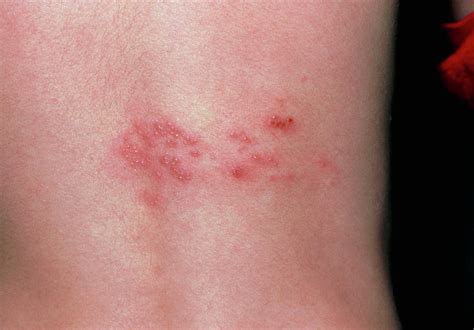 Rash Of Shingles (herpes Zoster) On Lower Back Photograph by Dr P. Marazzi/science Photo Library