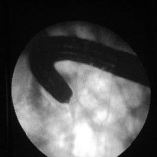 (PDF) The prone 12 o'clock position reduces ileal intubation time during colonoscopy compared to ...