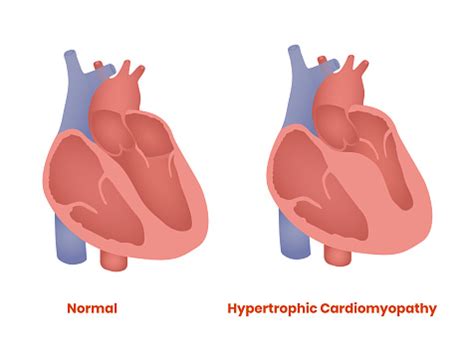 hypertrophic cardiomyopathy and hot weather