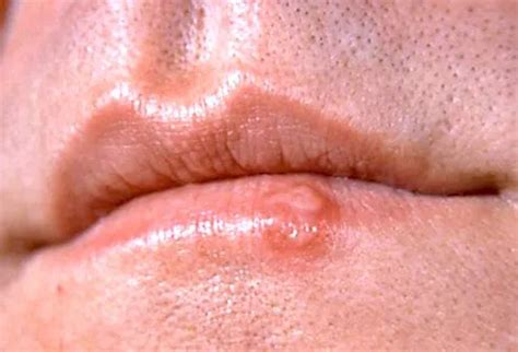 Rosacea, Acne, Shingles, Covid-19 Rashes: Common Adult Skin Diseases