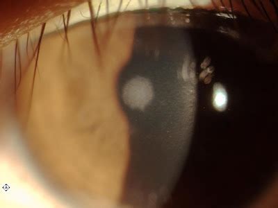 Sonoran Desert Eye Center: SCAR ON CORNEA FROM ULCER RELATING FROM CONTACT LENS OVERWEAR