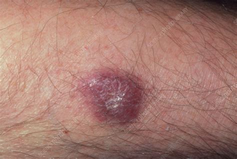 Kaposi's sarcoma lesion on leg of an AIDS patient - Stock Image - M112/0213 - Science Photo Library