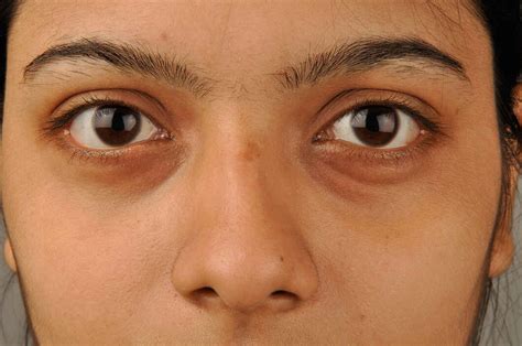 Causes Of Swollen Puffy Under Eyes - Infoupdate.org