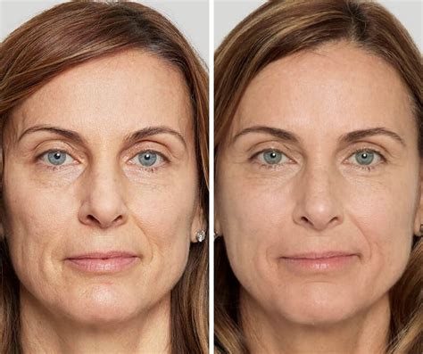 Rid Your Face of Smile Lines with Sculptra Aesthetic | The Skin Clinic ...