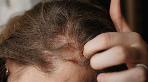 Know The Difference Between Scalp Psoriasis and Eczema