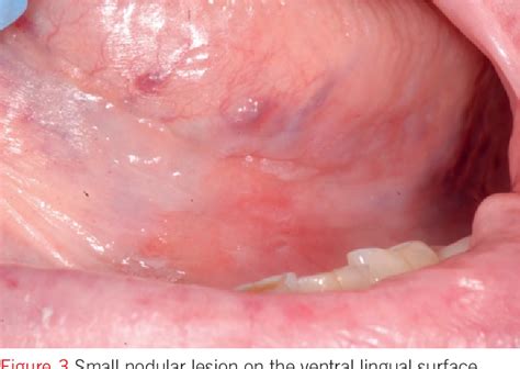 Figure 1 from The early diagnosis of small-sized oral squamous cell carcinoma : a challenge for ...