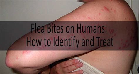 Flea Bite on Human: Flea Bites vs Mosquito Bites vs Bed Bug Bites