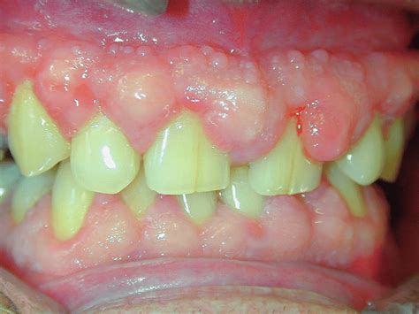 Amlodipine Gingival Hyperplasia