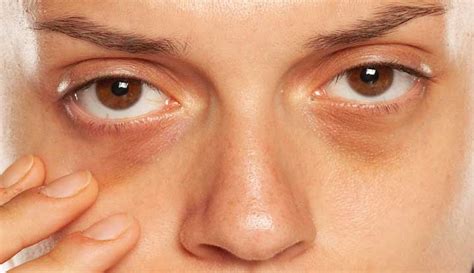 Top 19 what causes dark circles under eyes 2022