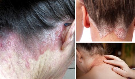 Psoriasis on the neck – Causes, Symptoms & Treatment | Psoriasis expert