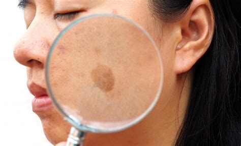 Recognizing a Seborrheic Keratosis (And Why It Matters): Ali Hendi, MD ...