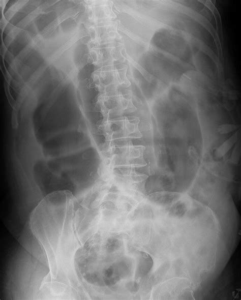 Large-Bowel Obstruction in the Adult: Classic Radiographic and CT Findings, Etiology, and Mimics ...