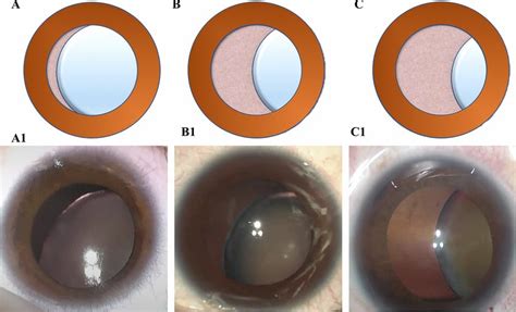 Different degrees of lens subluxation. (A) and (A1). Mild: lens edge... | Download Scientific ...