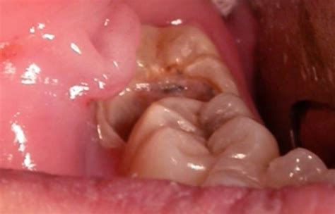 Wisdom Tooth Infection - Symptoms, Causes, Treatment, Pictures - (2018 - Updated)