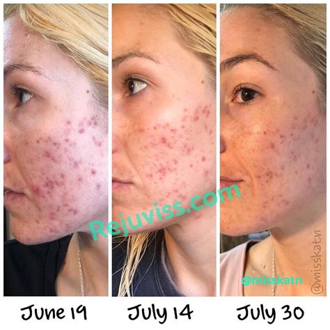 Dermaroller Before And After Pores - From the beginning, i varied the ...