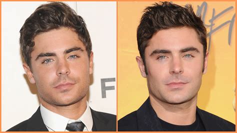 Here’s What Zac Efron Looked Like Before and After His Accident