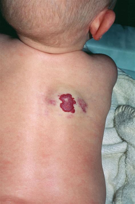 Strawberry Birthmark Photograph by Mike Devlin/science Photo Library