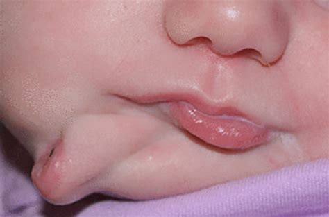 Baby born with two mouths and two sets of teeth as a result of rare ...