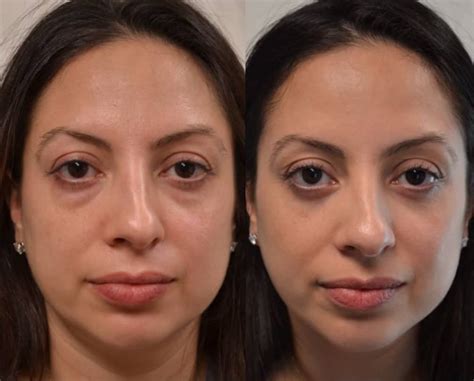 Lower Blepharoplasty Before and After Photos | Fresh Face + Eye