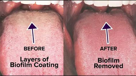 Tongue Rejuvenation: The ANSWER to Fixing Chronic Bad Breath ...