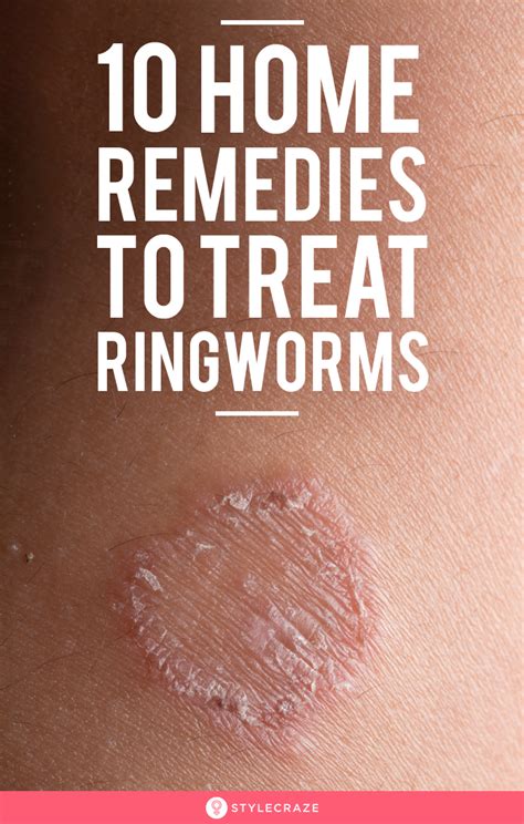 10 best natural home remedies for ringworm treatment – Artofit