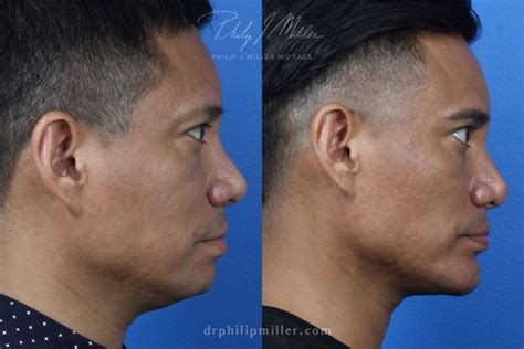 What are the best procedures for neck tightening in 2024? - Philip ...