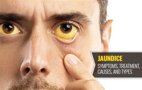 Get The Best Treatment For Jaundice From The Best Hospital - Home