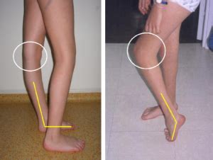 Flexion Deformity of the Knee - Physiopedia