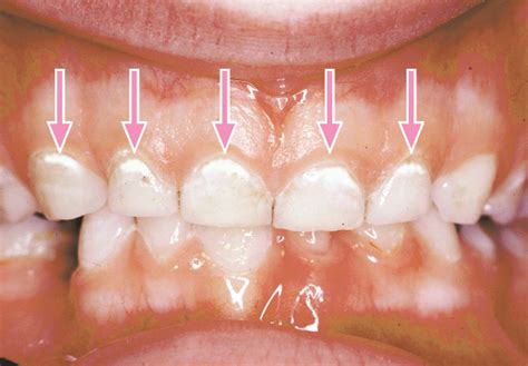 Early Dental Cavity