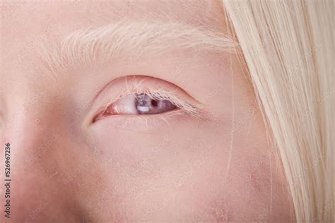 Close-up of young face of albino girl with blue eyes and white ...