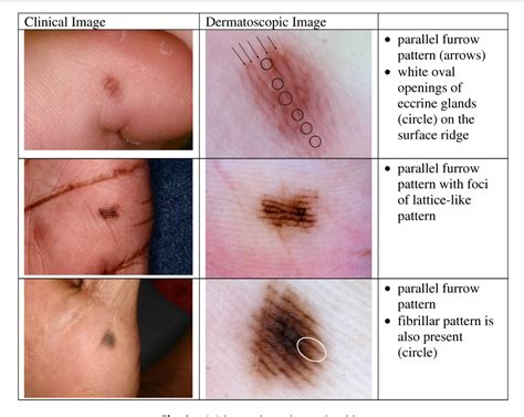 Figure 3 from Dermatoscopy: an overview of subsurface morphology ...