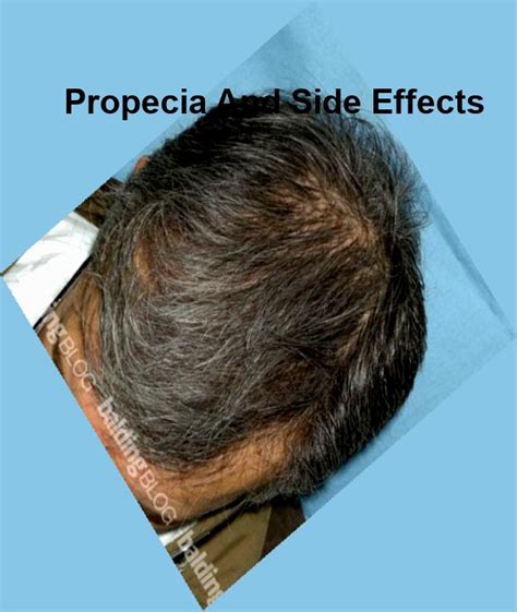 Negative side effects of propecia, propecia and sex drive - Pill shop, No prescription needed ...