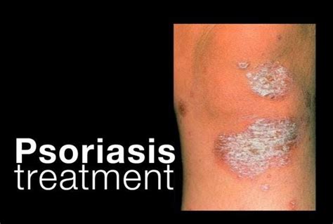 Psoriasis Treatment Options | ByteVarsity