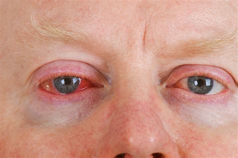 Bloodshot Eyes: Should you be concerned? - Kadrmas Eye Care New England