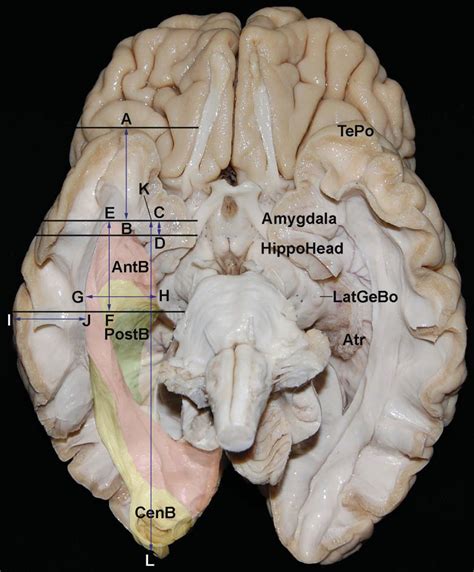 Inferior View of the Optic Radiation With Measurements | Neuroanatomy | The Neurosurgical Atlas