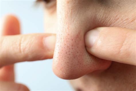 Blackheads and Whiteheads – Causes, Prevention & Treatment Tips