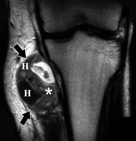 Imaging of Synovial Sarcoma with Radiologic-Pathologic Correlation | RadioGraphics