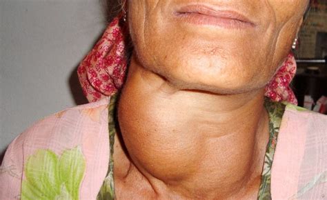 11 Goiter Treatment Without Surgery, Causes and Symptoms | The News God